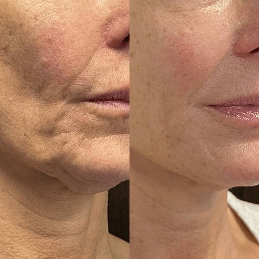 The Complete Micro-Infusion Lift Pro® Routine