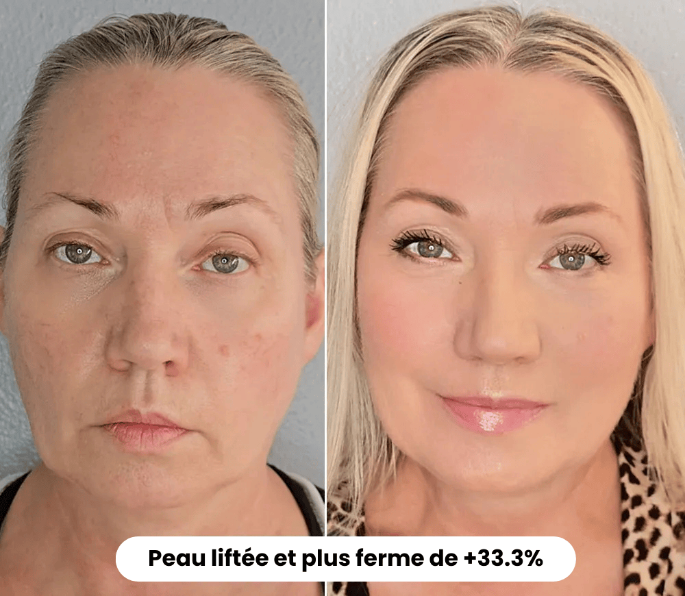 The Complete Micro-Infusion Lift Pro® Routine