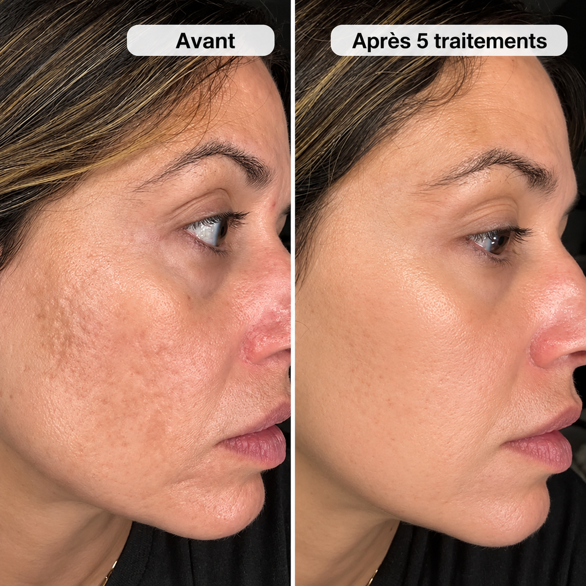 Micro-Infusion PDRN Marques d&