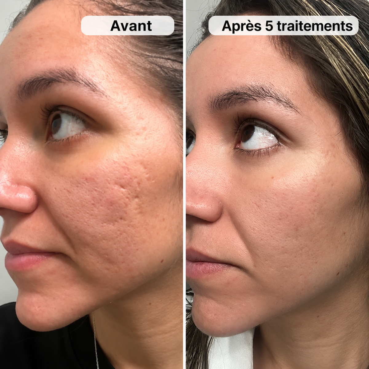 Micro-Infusion PDRN Marques d&