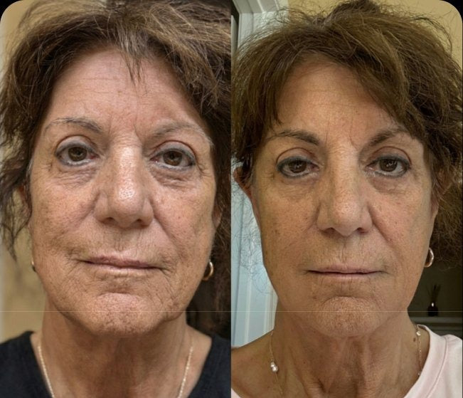 The Micro Infusion System™