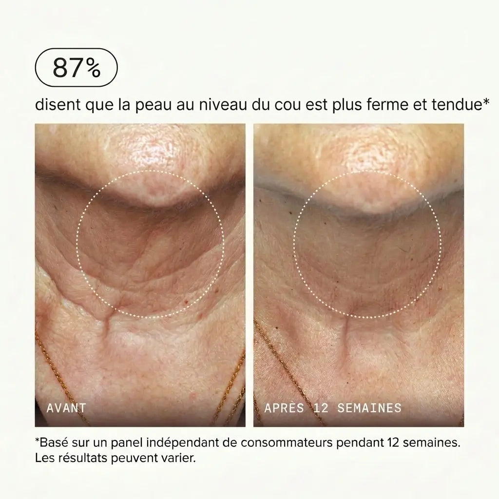 Micro-Infusion PDRN