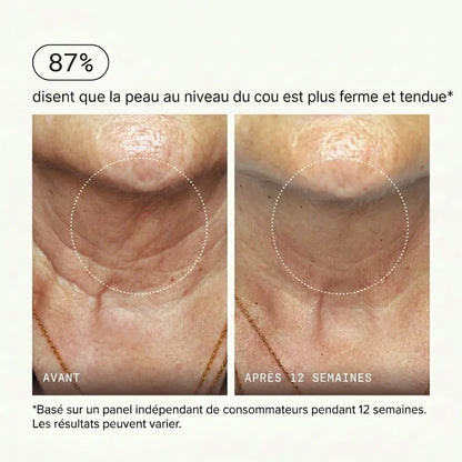 Micro-Infusion PDRN